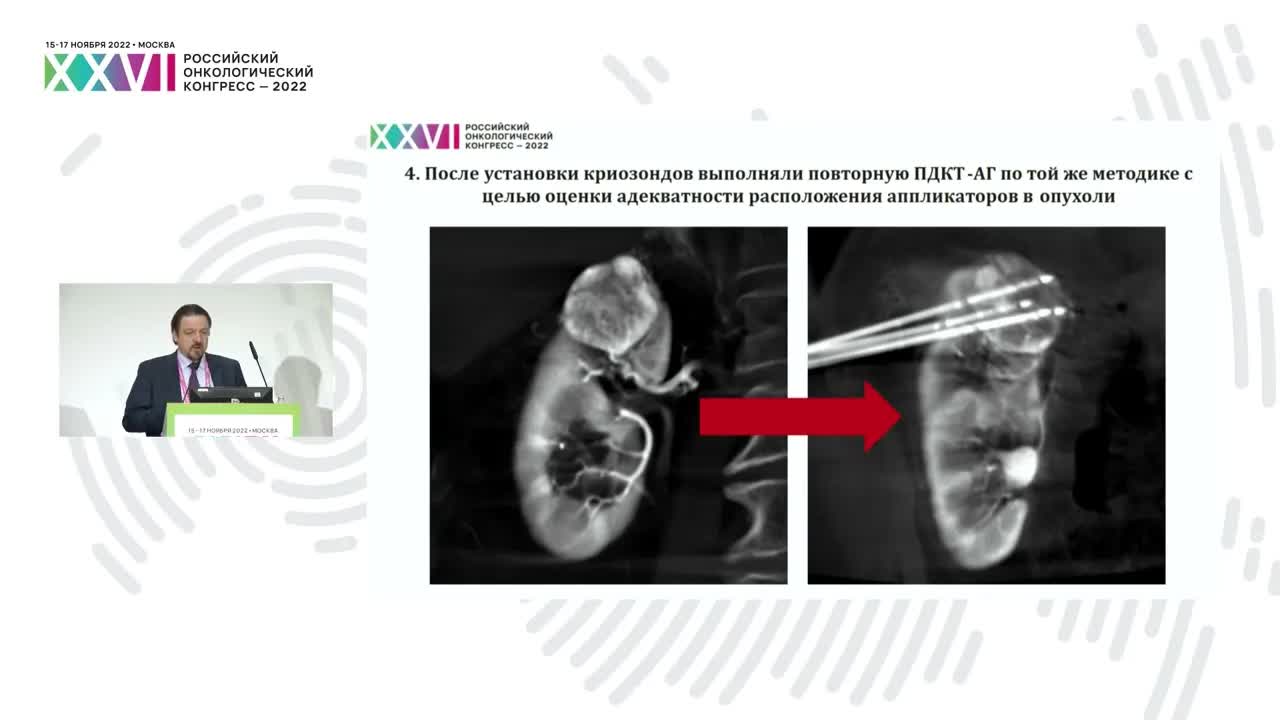 Аблативные технологии при опухолях почек