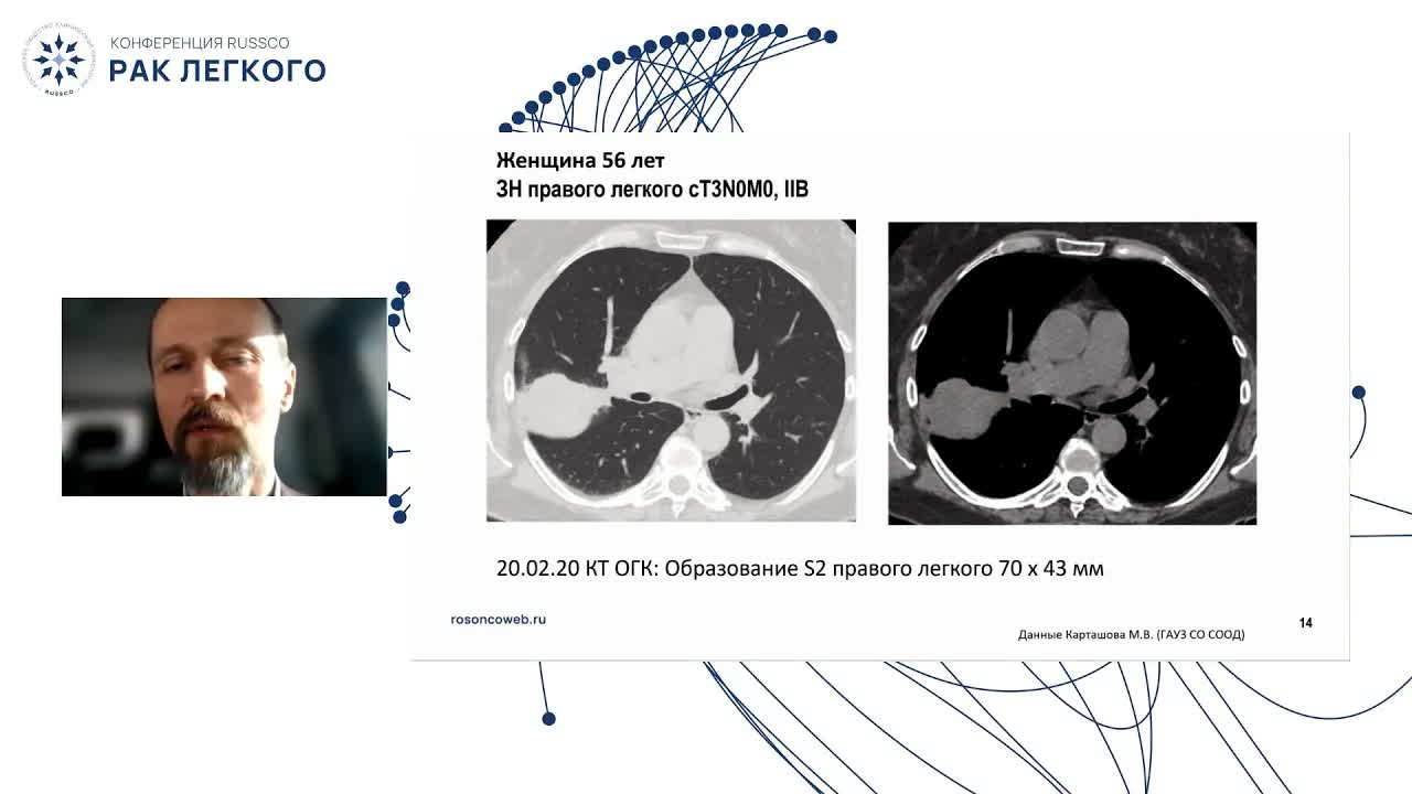 Локализованный рак легкого. Клинический случай 3