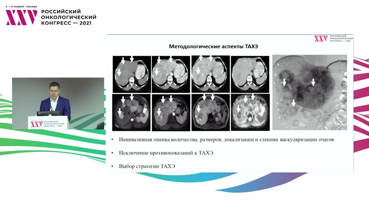 Рентгеноэндоваскулярные методы при метастазах нейроэндокринных опухолей в печени