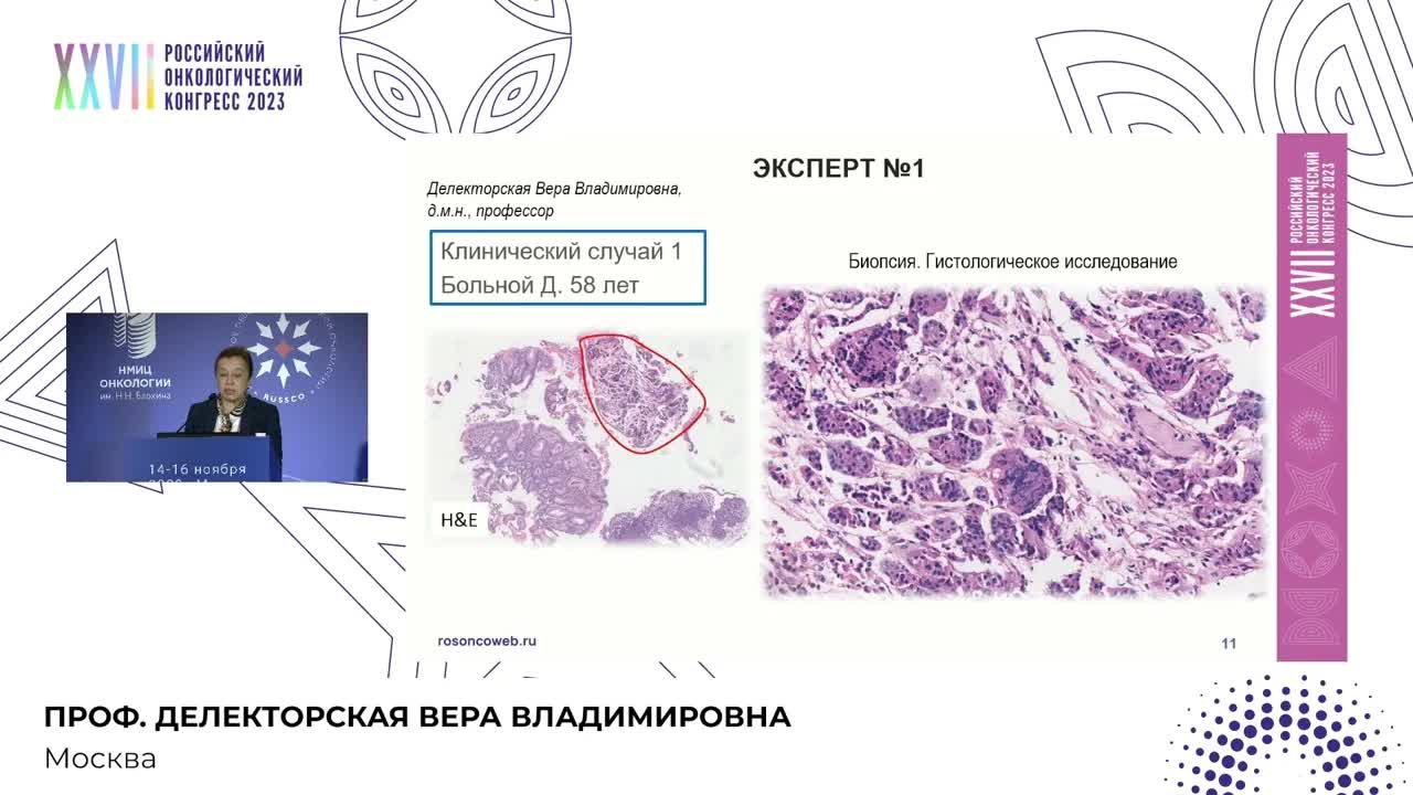 Эти похожие/не очень опухоли (обсуждение лечения крупноклеточного нейроэндокринного рака желудка)