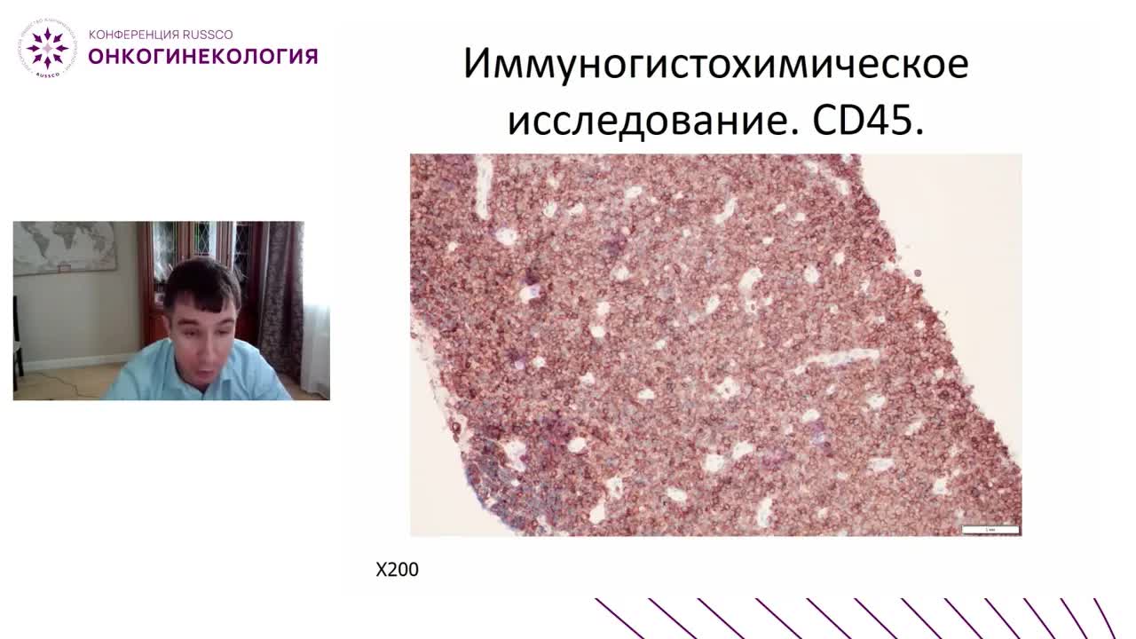 редкие формы рака шейки матки, когда надо выполнять ИГХ исследование