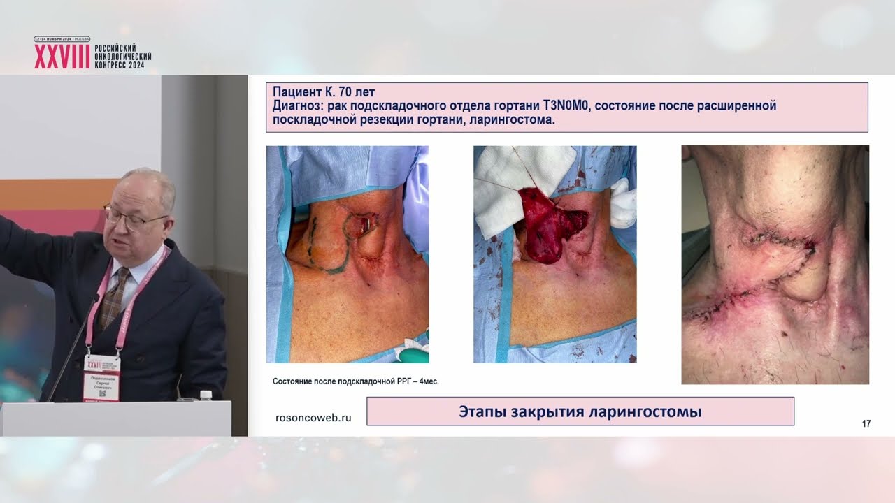 Расширенные резекции – как метод органосохранного лечения местнораспространенного рака гортани