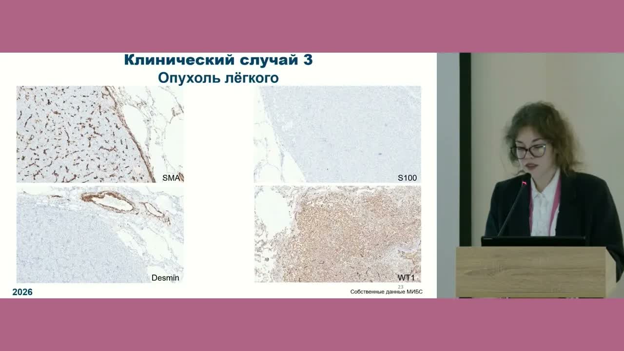 Интеграция морфологии и молекулярной генетики в дифференциальную диагностику сарком матки