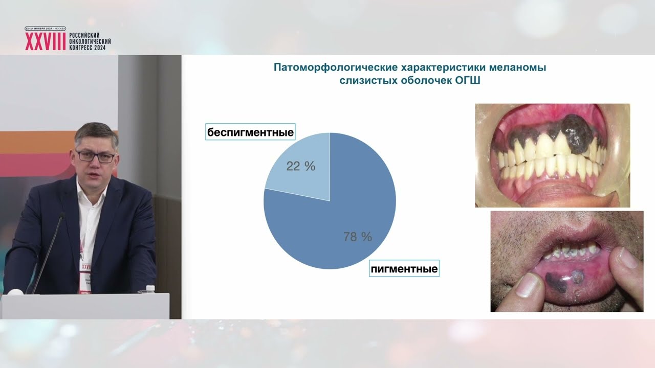 Меланома слизистых оболочек органов головы и шеи. Особенности диагностики и лечения