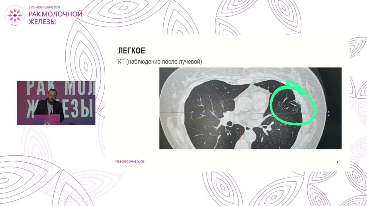 Ограничения на органы риска при ускоренном гипофракционировании при РМЖ