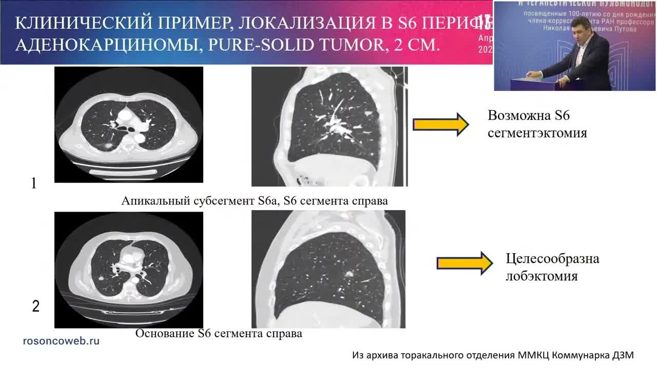 Торакоскопическая хирургия при локализованных формах периферического рака легкого