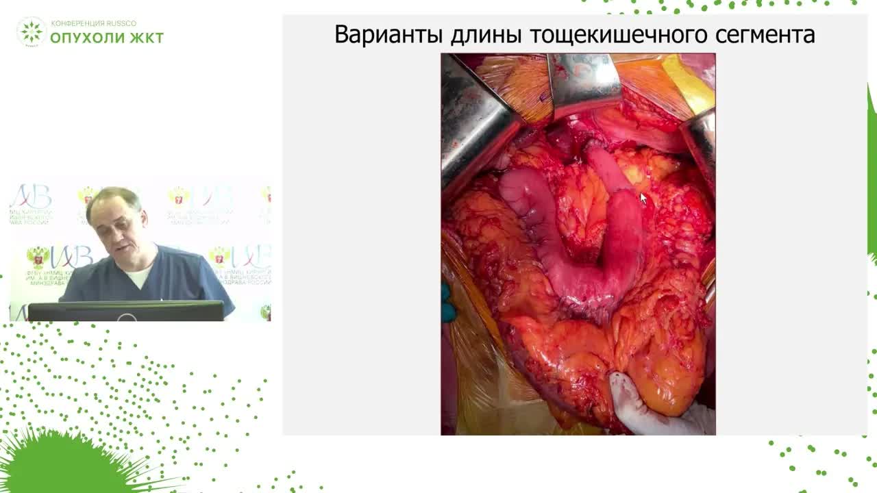 Операция Merendino-Dillard в хирургии рака пищеводно-желудочного перехода