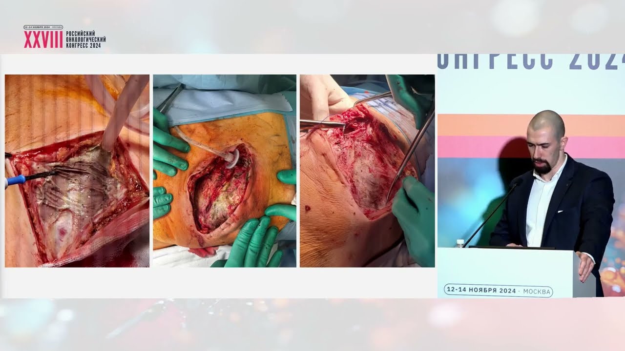 Некротические инфекции мягких тканей в онкохирургии