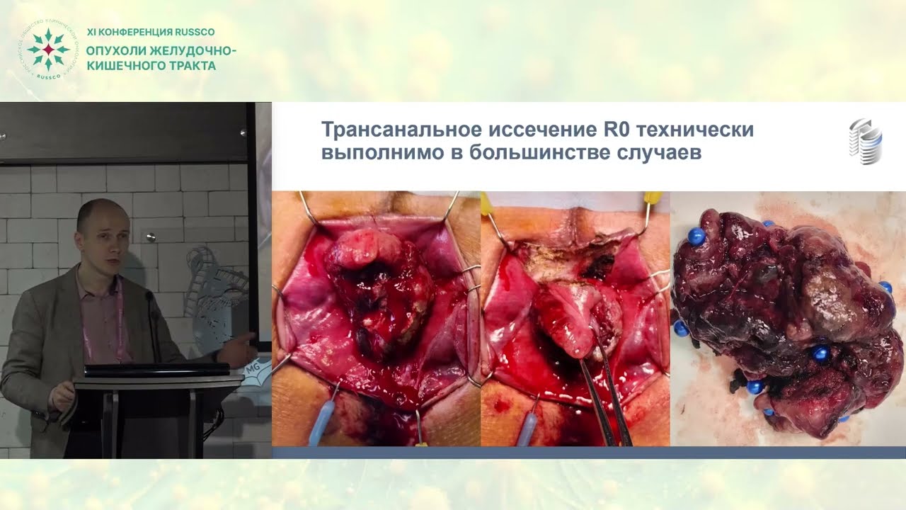 Редкие онкологические заболевания в практике онкопроктолога: взгляд хирурга