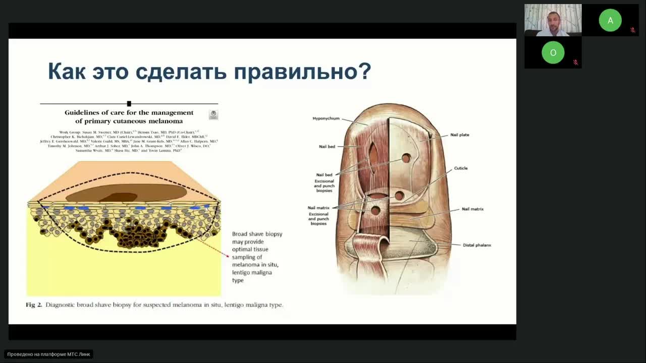 Меланома (вебинар 20 октября 2023)