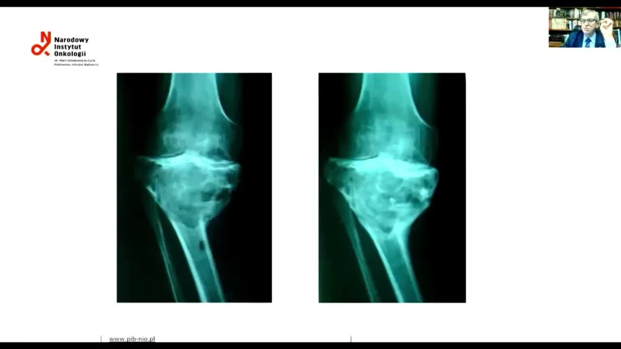 Деносумаб в лечении гигантоклеточной опухоли кости (Giant cell tumor and Denosumab)
