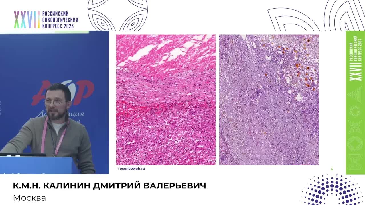 Морфологическая диагностика молекулярных подтипов гепатоцеллюлярных аденом