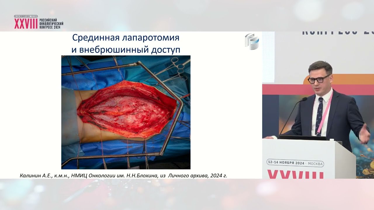 Хирургия псевдомиксомы: как мы это делаем (А.Е. Калинин)
