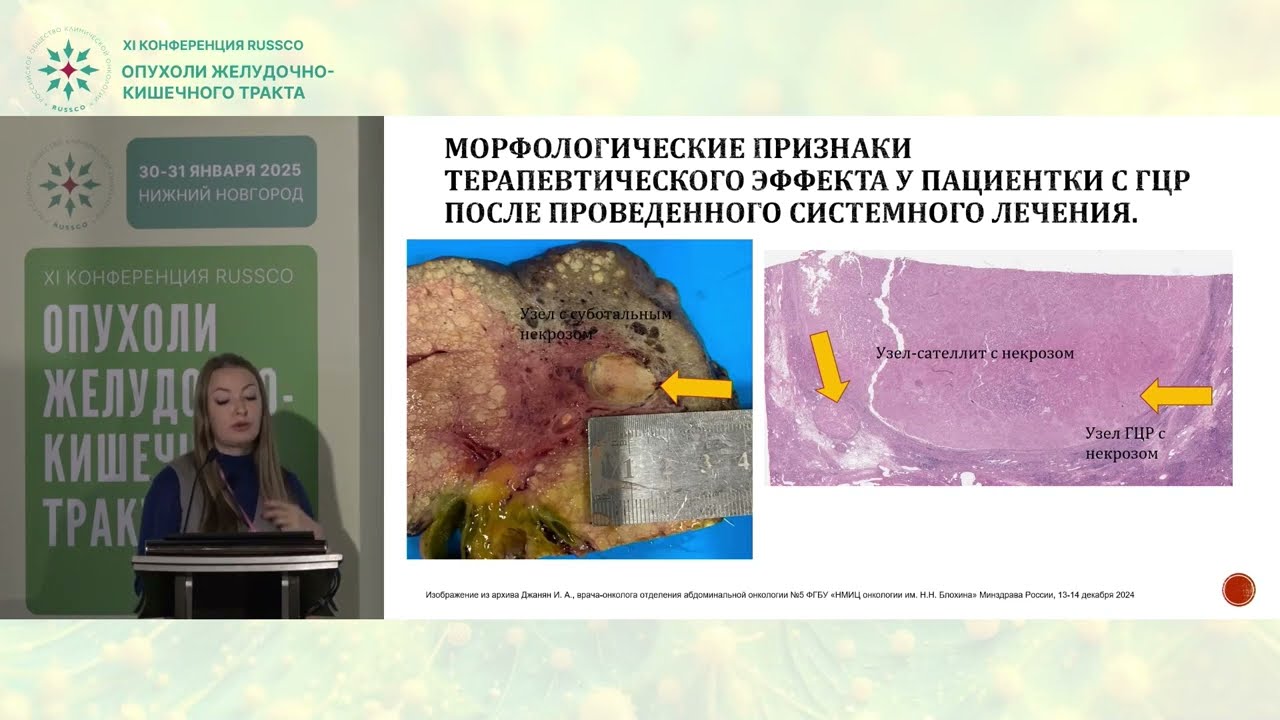 Нужно ли стремиться к достижению критериев трансплантации печени при ГЦР? Что дает иммунотерапия?