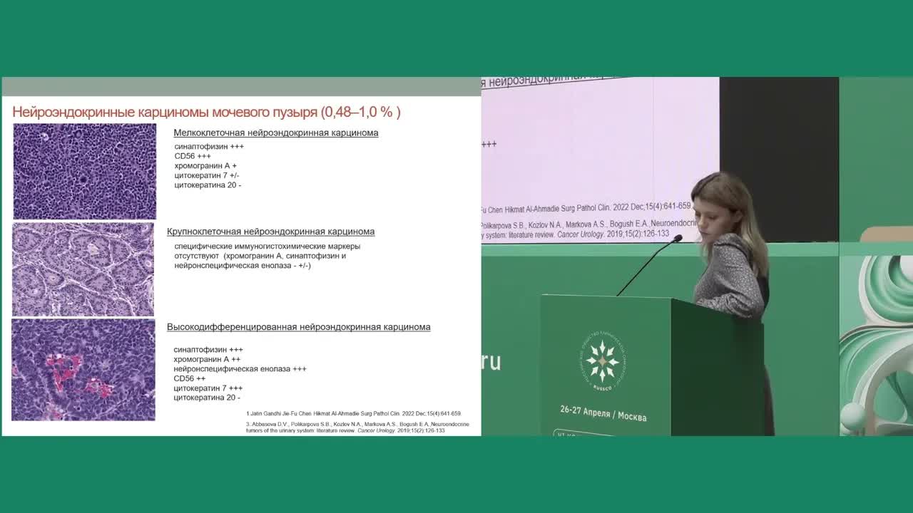 редкие опухоли мочевого пузыря: обзорный доклад