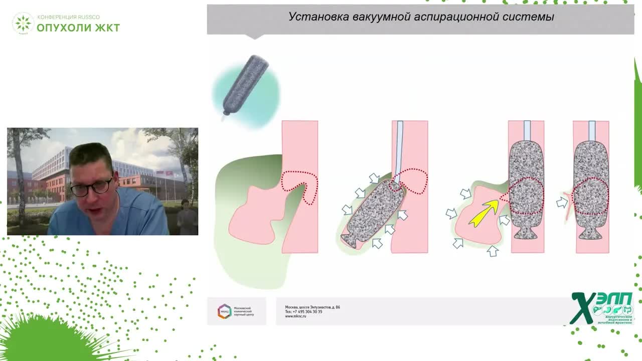 Эндоскопические методы лечения послеоперационных осложнений у больных раком пищевода и желудка