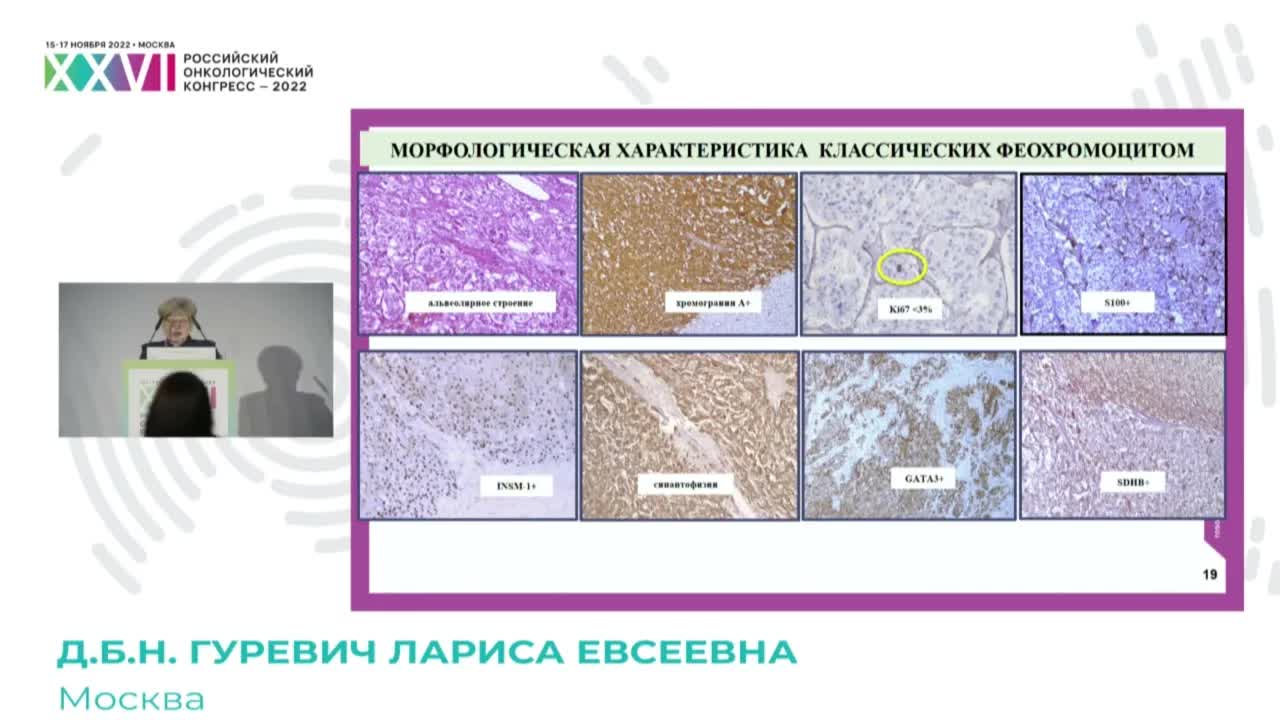 Морфологическая оценка злокачественности феохромоцитом и параганглиом