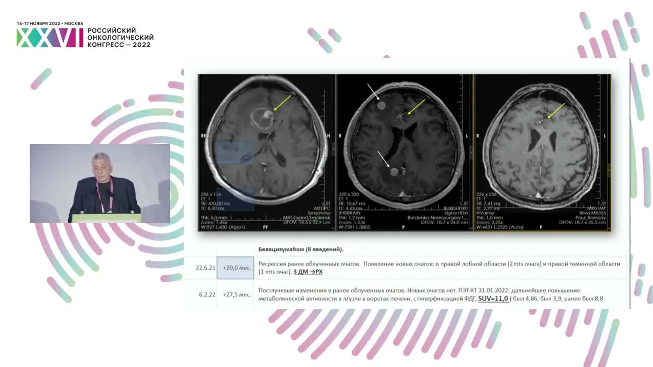 Стереотаксическая радиотерапия пациентов с метастазами меланомы в головной мозг