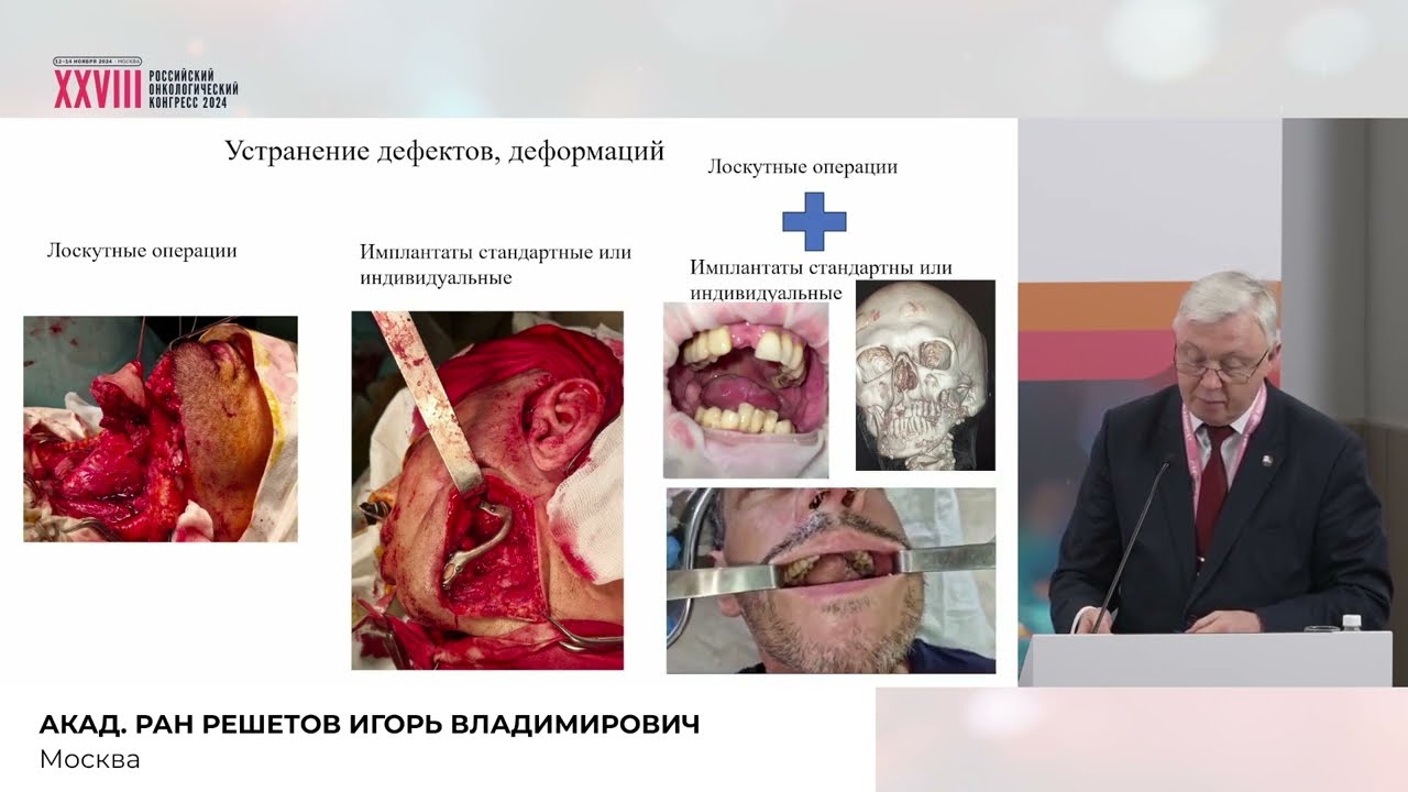 Аддитивные технологии в лечении современной челюстно-лицевой травмы 