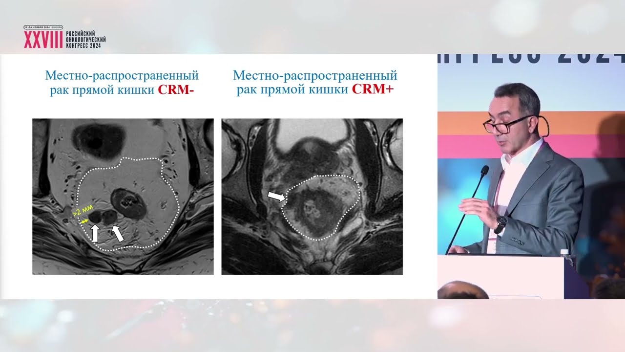 Все ли местнораспространенные раки прямой кишки одинаковые?