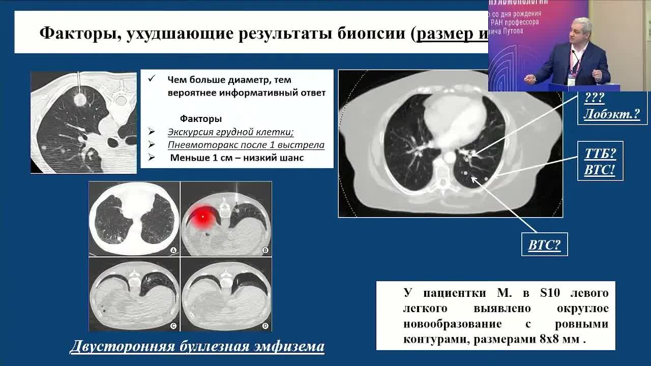 Хирургия периферических новообразований легкого без верификации: рационализм или волюнтаризм