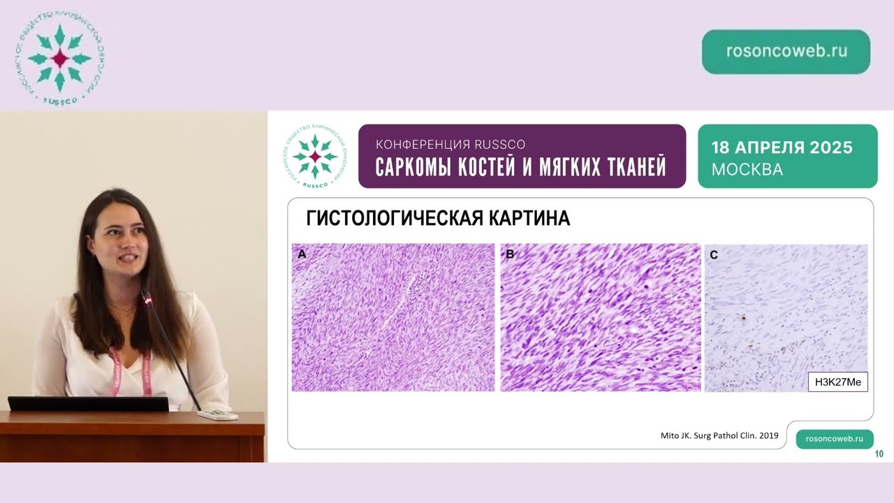 Радиоиндуцированные саркомы – как часто бывает, ее морфологические признаки и прогноз