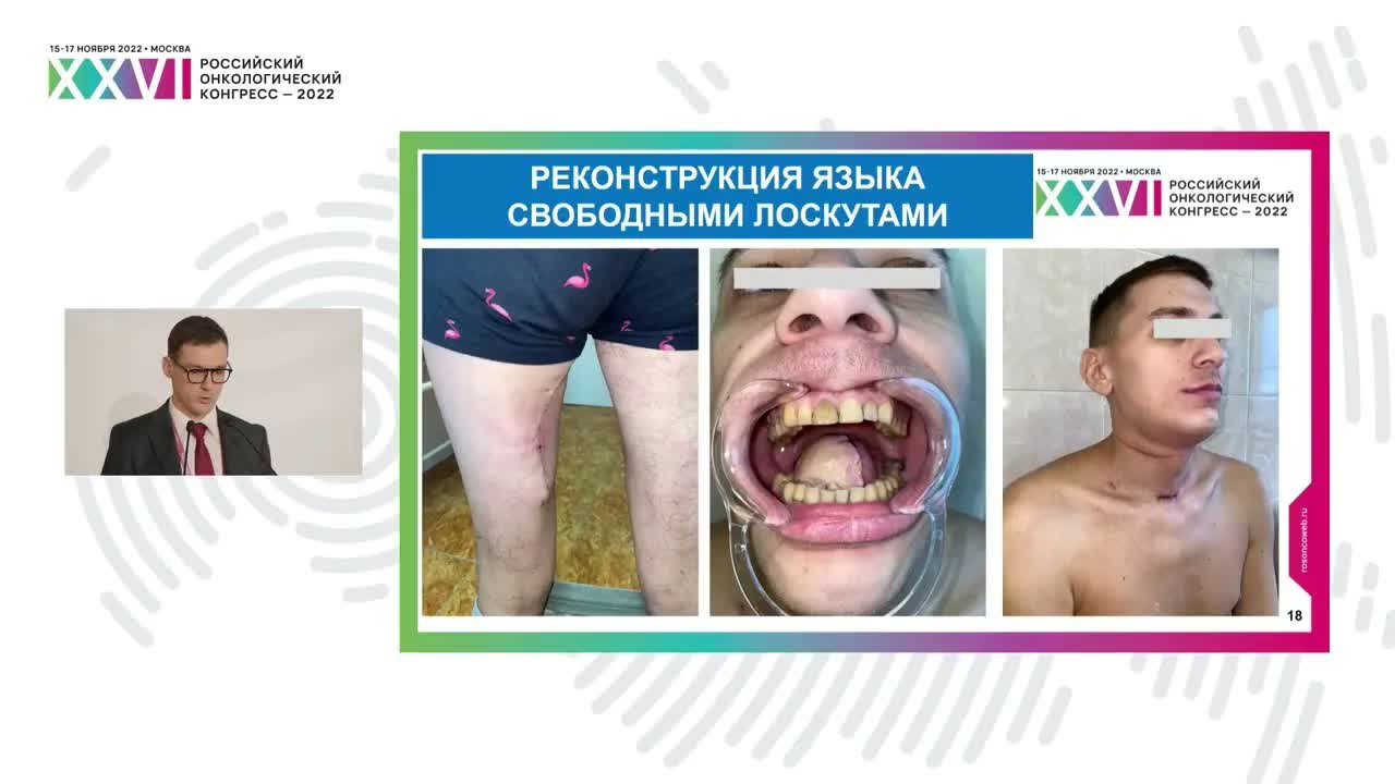 Хирургический этап с реконструктивным компонентом в лечении больных раком полости рта