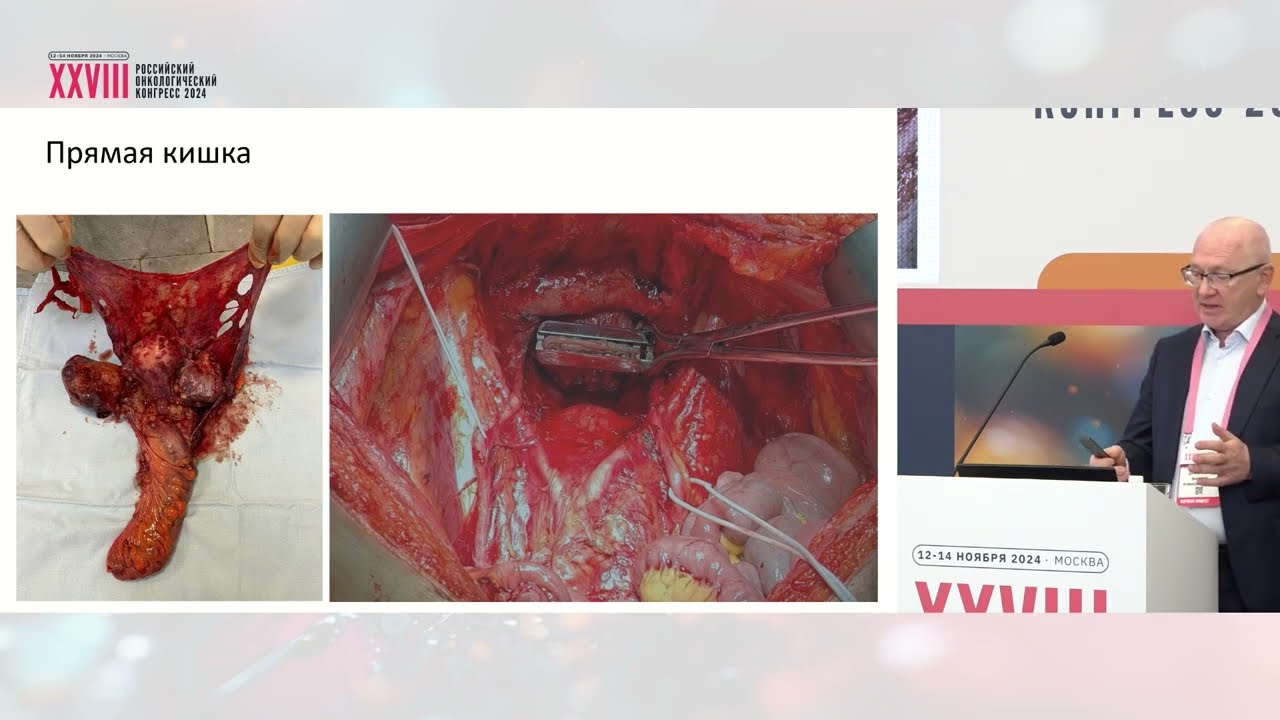 Хирургия псевдомиксомы: как мы это делаем (А.А. Доманский)