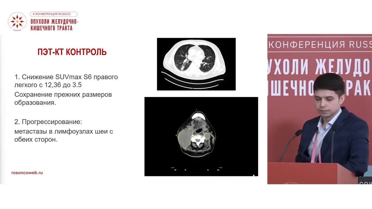 Разбор клинического наблюдения олигометастатического заболевания при опухоли пищевода