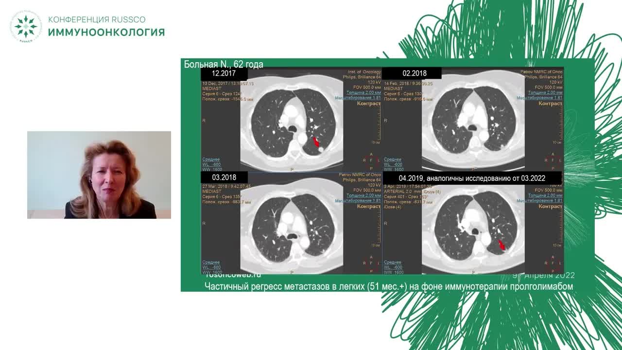 Олигометастатическое поражение ЦНС (бессимптомное)