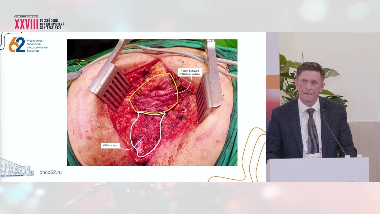 Лап БПЭ с резекцией влагалища и одномоментной пластикой VRAM лоскутом и глютеопластикой тазового дна