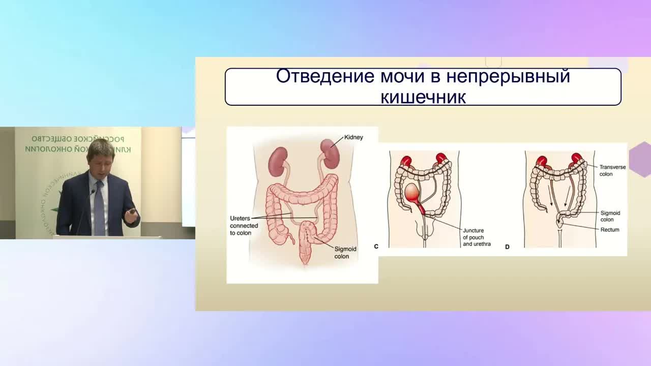 Принципы хирургического лечения мышечно-инвазивного уротелиального рака мочевого пузыря