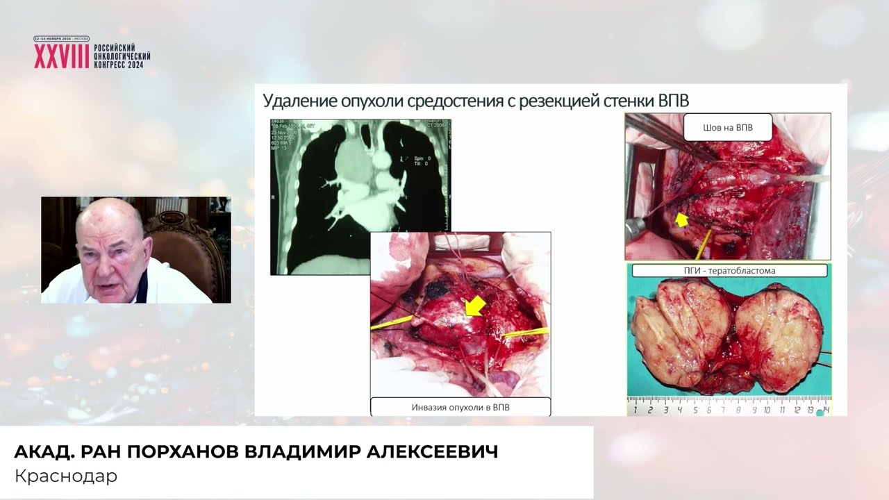 Гигантские опухоли средостения