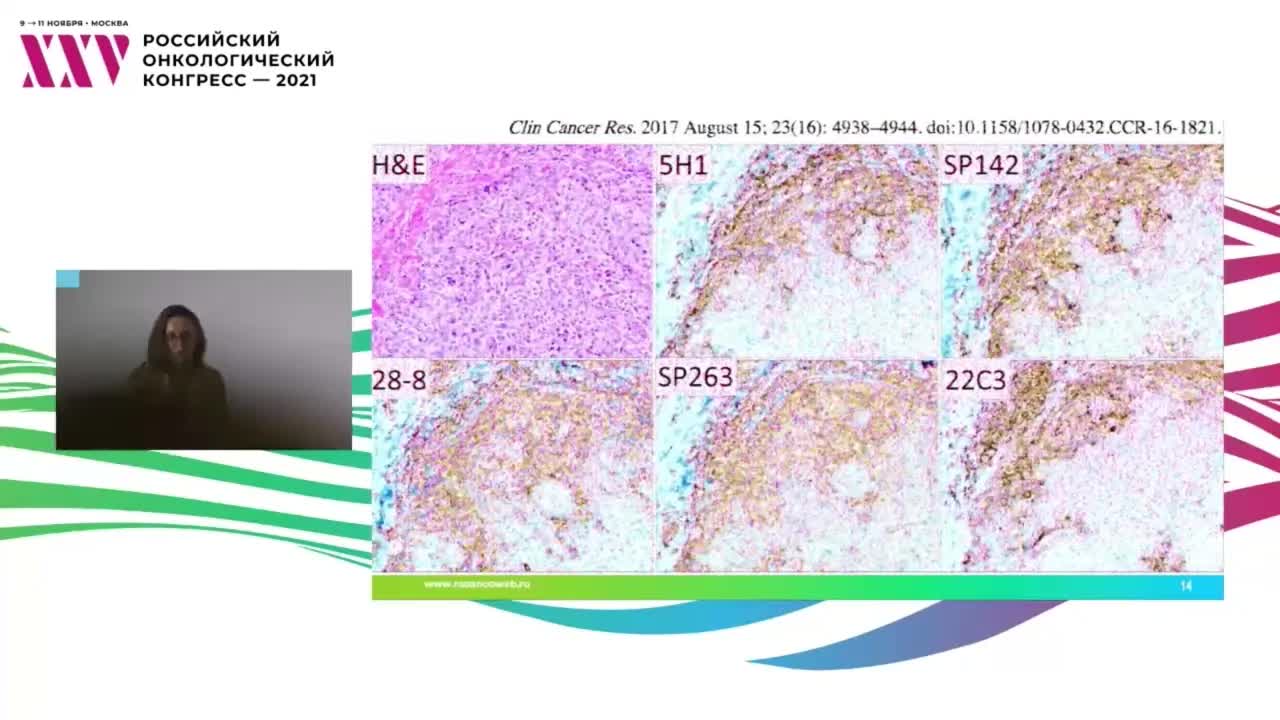 Меланома: морфологические аспекты определения экспрессии PD-L1