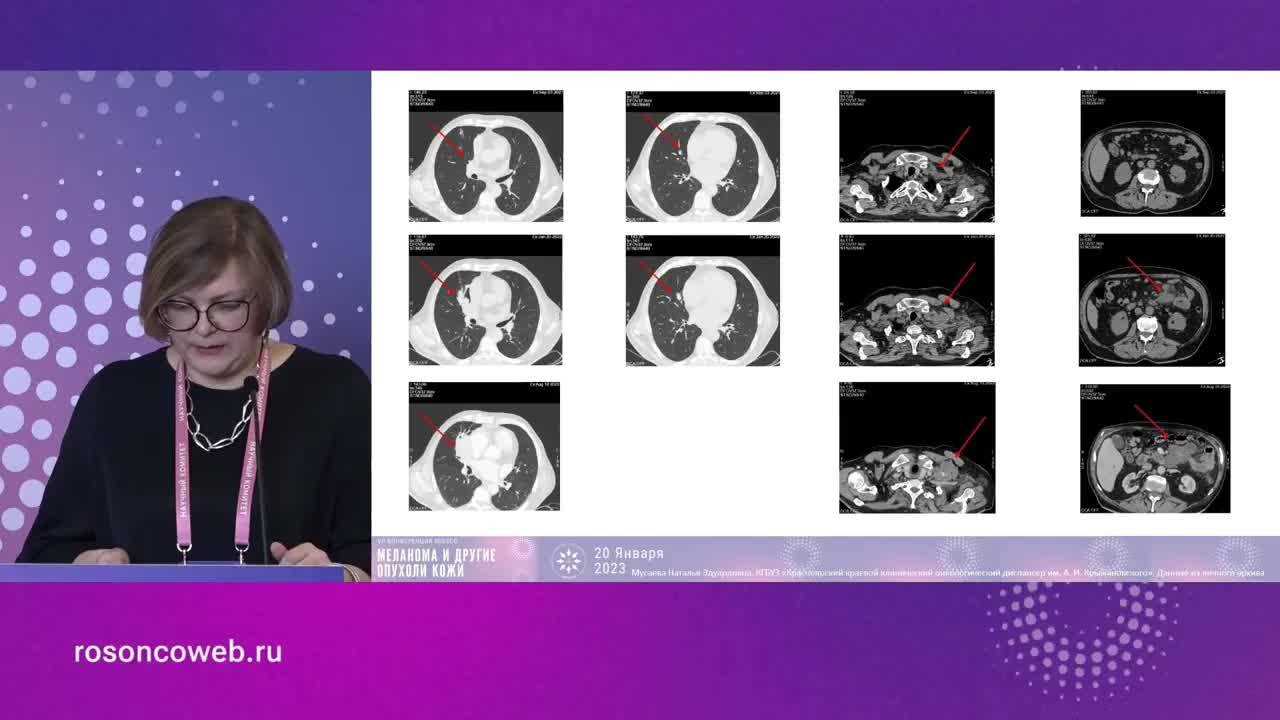 Лекарственная терапия BRAF меланомы. Прогрессирование на фоне таргетной терапии: комбинированная ИТ