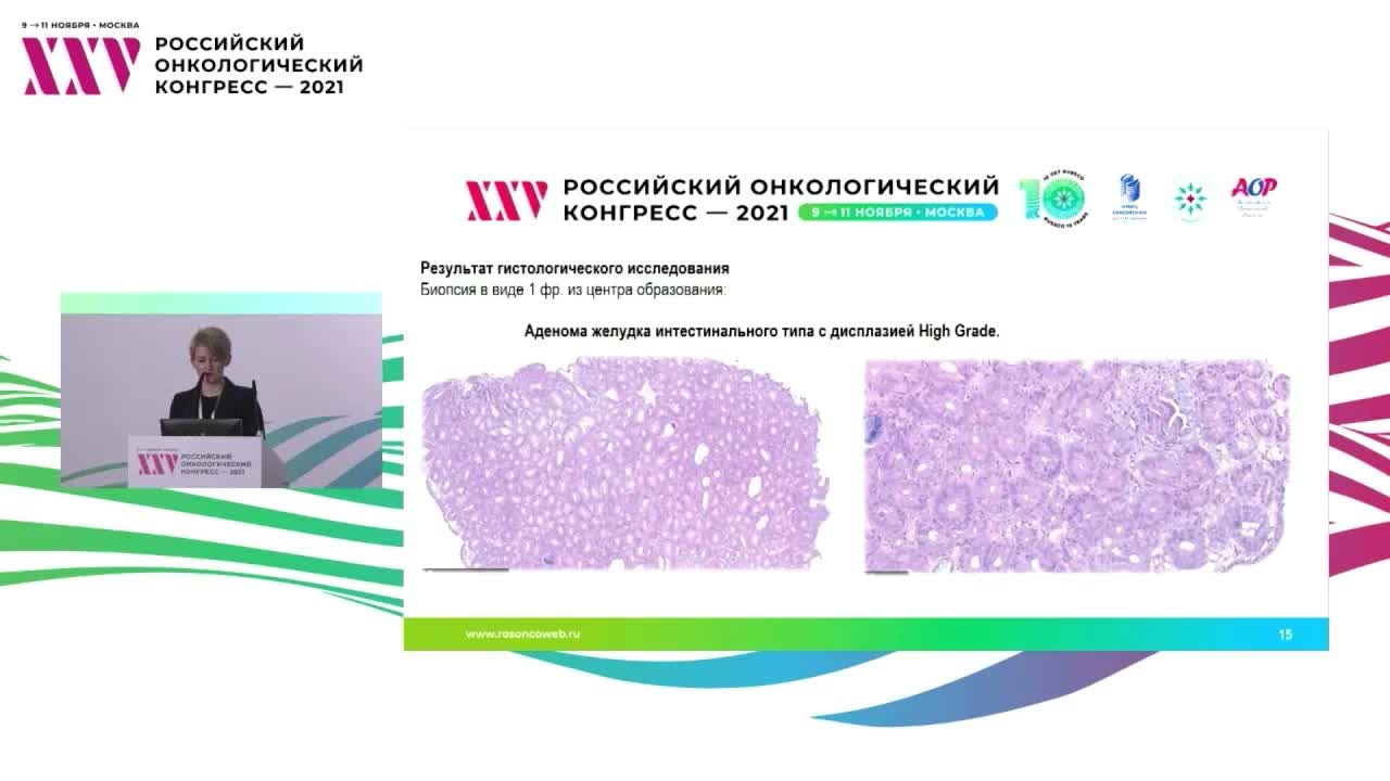 Полипы желудка: разбор клинических случаев. Аденома желудка