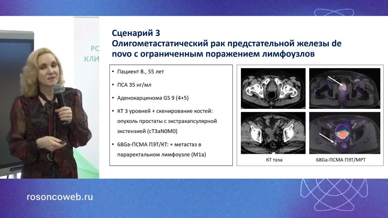 Лечение олигометастатического рака предстательной железы