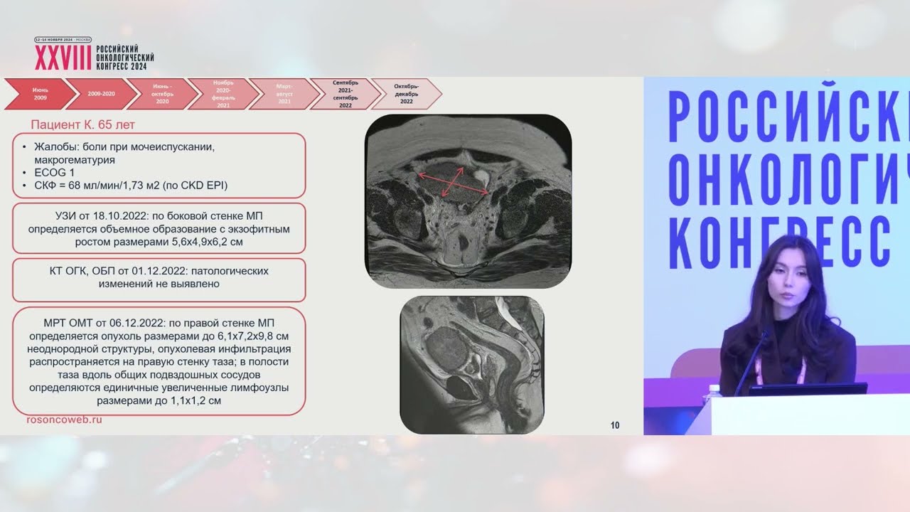 Обсуждение клинического случая мультидисциплинарной командой: мышечно-инвазивный рак мочевого пузыря