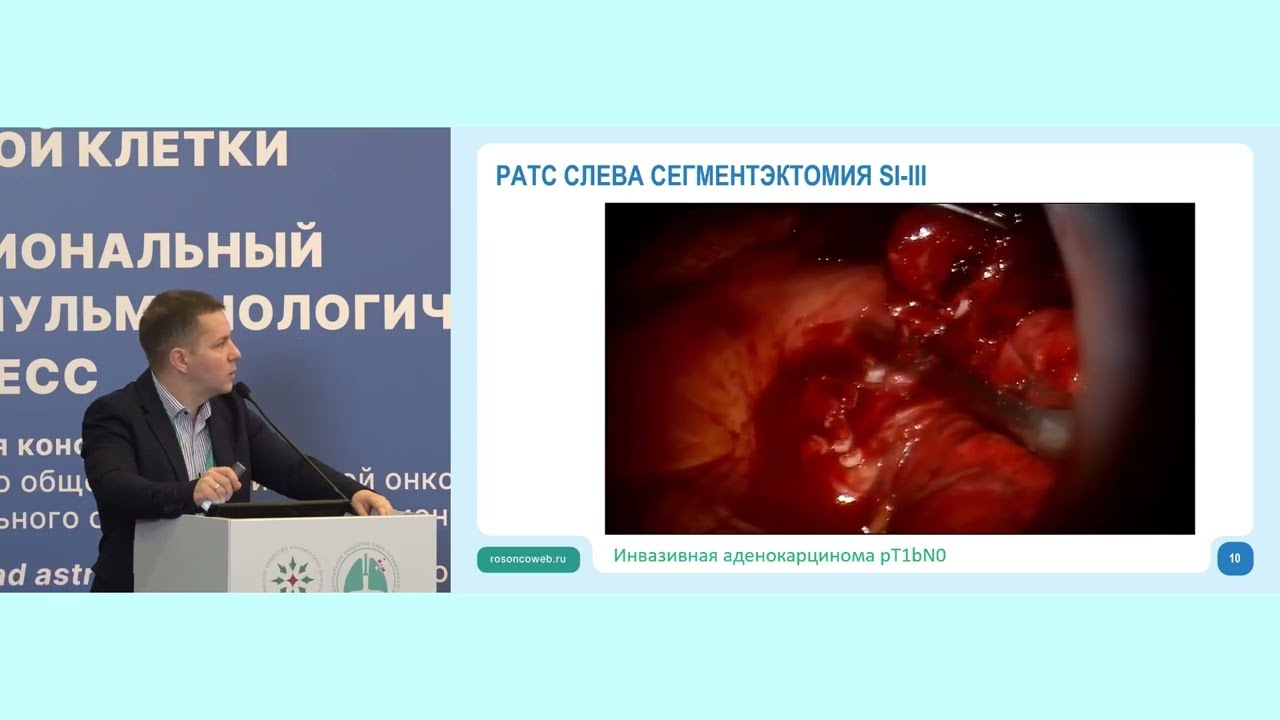 «Простые» сегментэктомии: Скороход А.А.