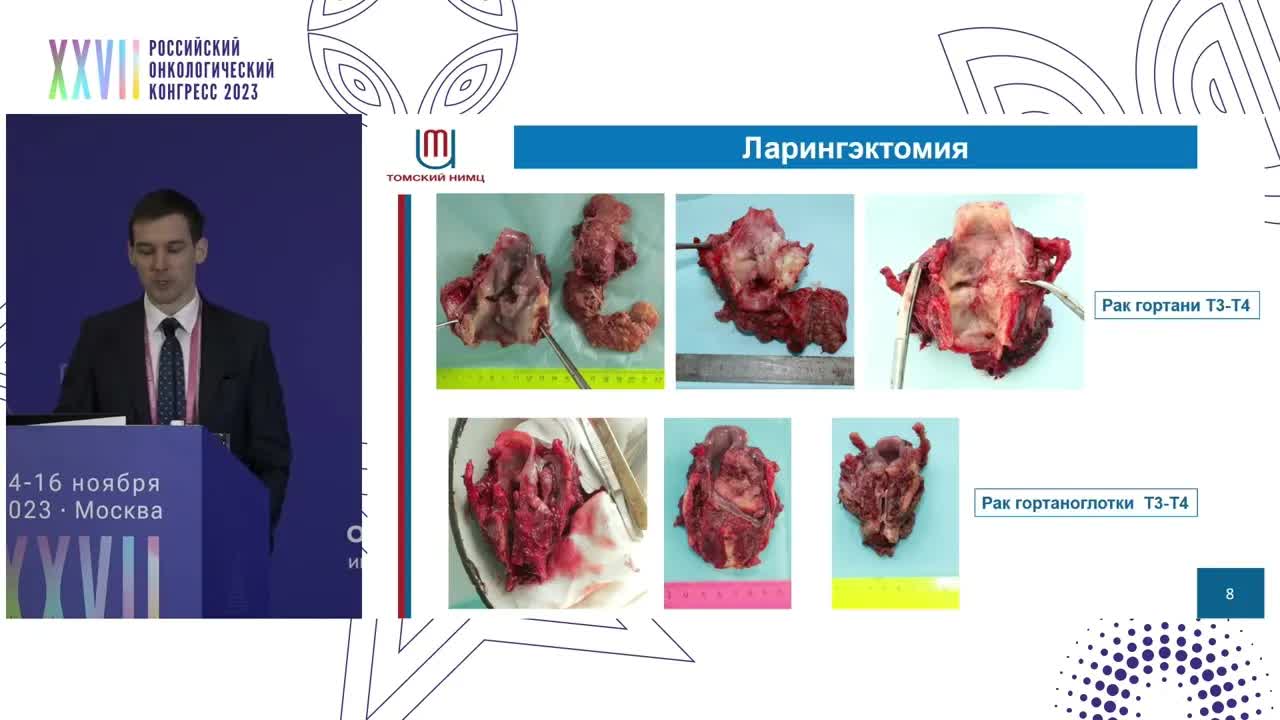 Субтотальная ларингэктомия с формированием трахеоглоточного шунта у больных раком гортани