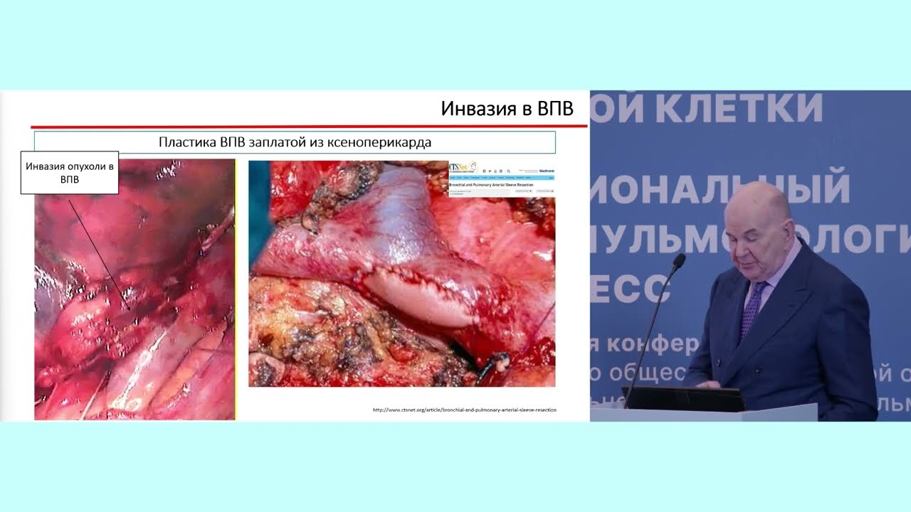 Ангиопластическая хирургия при местнораспространенных опухолях грудной клетки