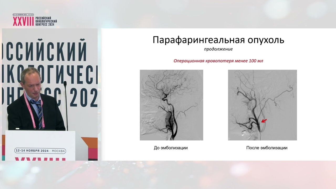 Эндоваскулярный гемостаз при опухолях головы и шеи