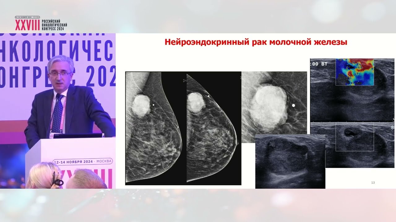 Нейроэндокринные опухоли молочной железы