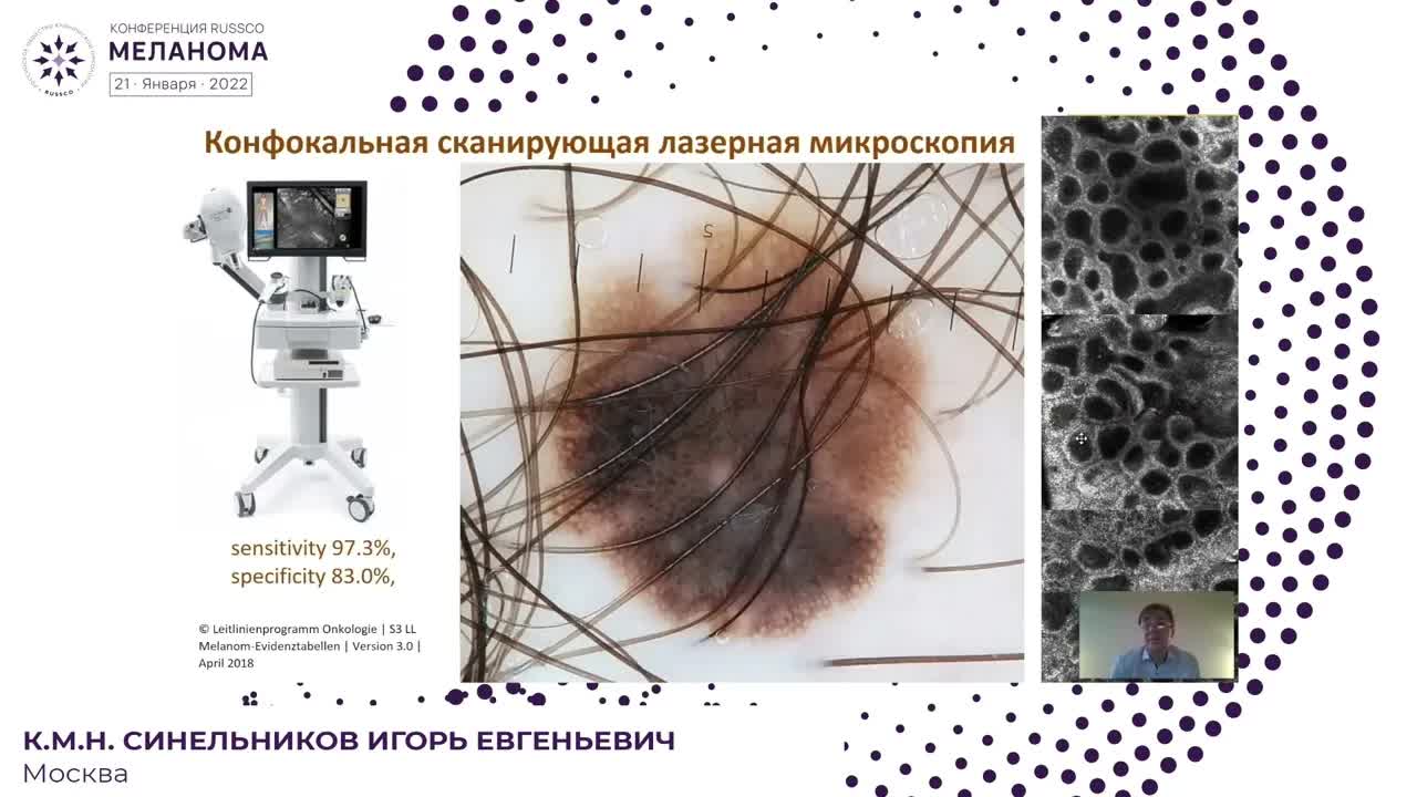 Современные возможности неинвазивной диагностики меланомы