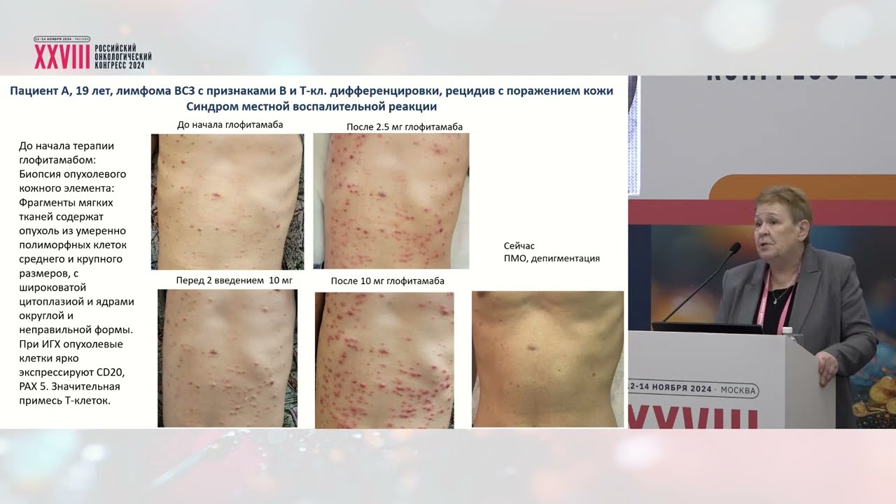 Биспецифические антитела в лечении неходжкинских лимфом