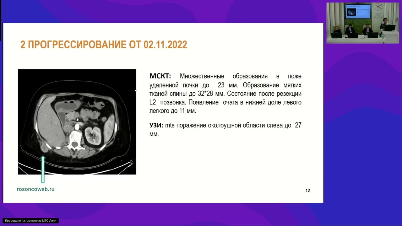 Циторедуктивное лечение больных метастатическим раком почки: разбор клинического случая 1