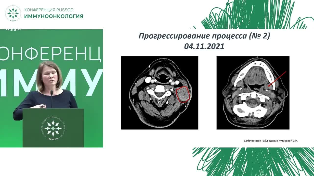 Иммуноонкология. Опухоли головы, шеи. Клинический случай
