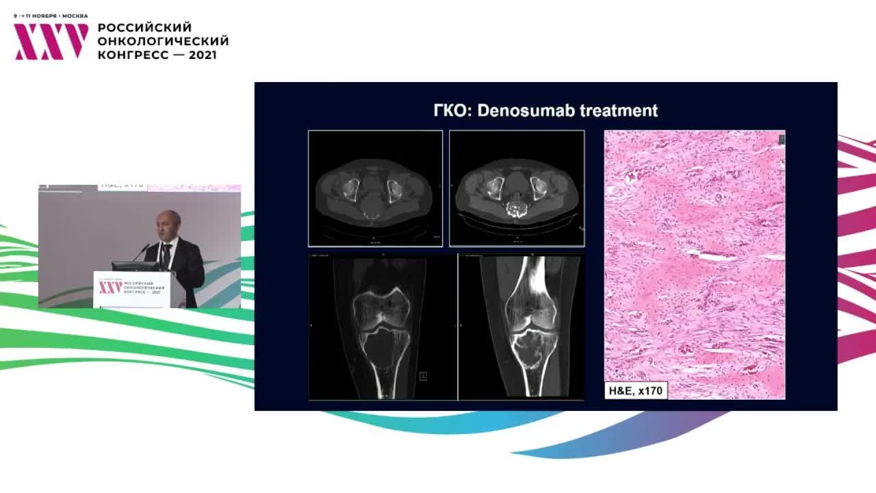 Дифференциальная диагностика гигантоклеточной опухоли