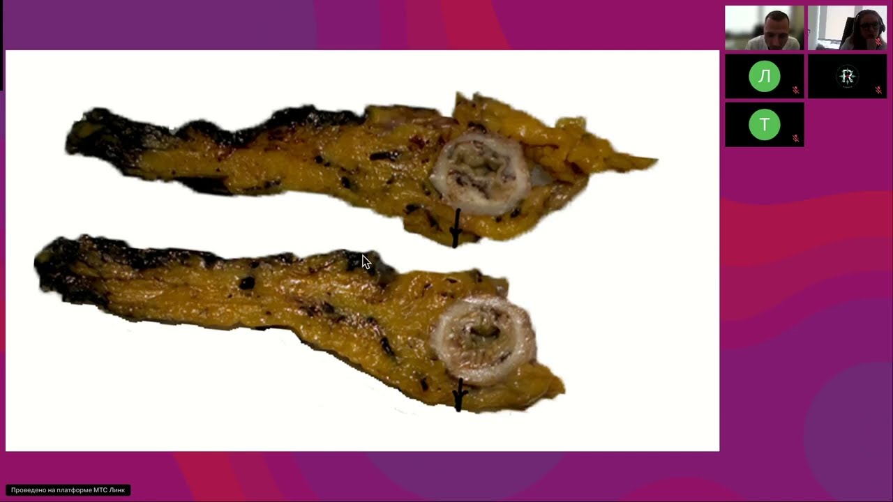 Лечение локализованного рака толстой кишки: важные аспекты принятия решения (вебинар 24 июня 2025)