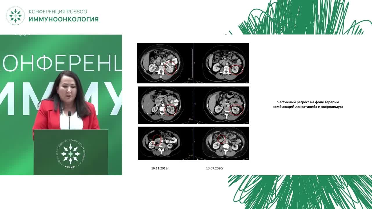 Иммуноонкология. Рак почки. Клинический случай